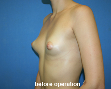 plastic-surgery-breast-augmentation